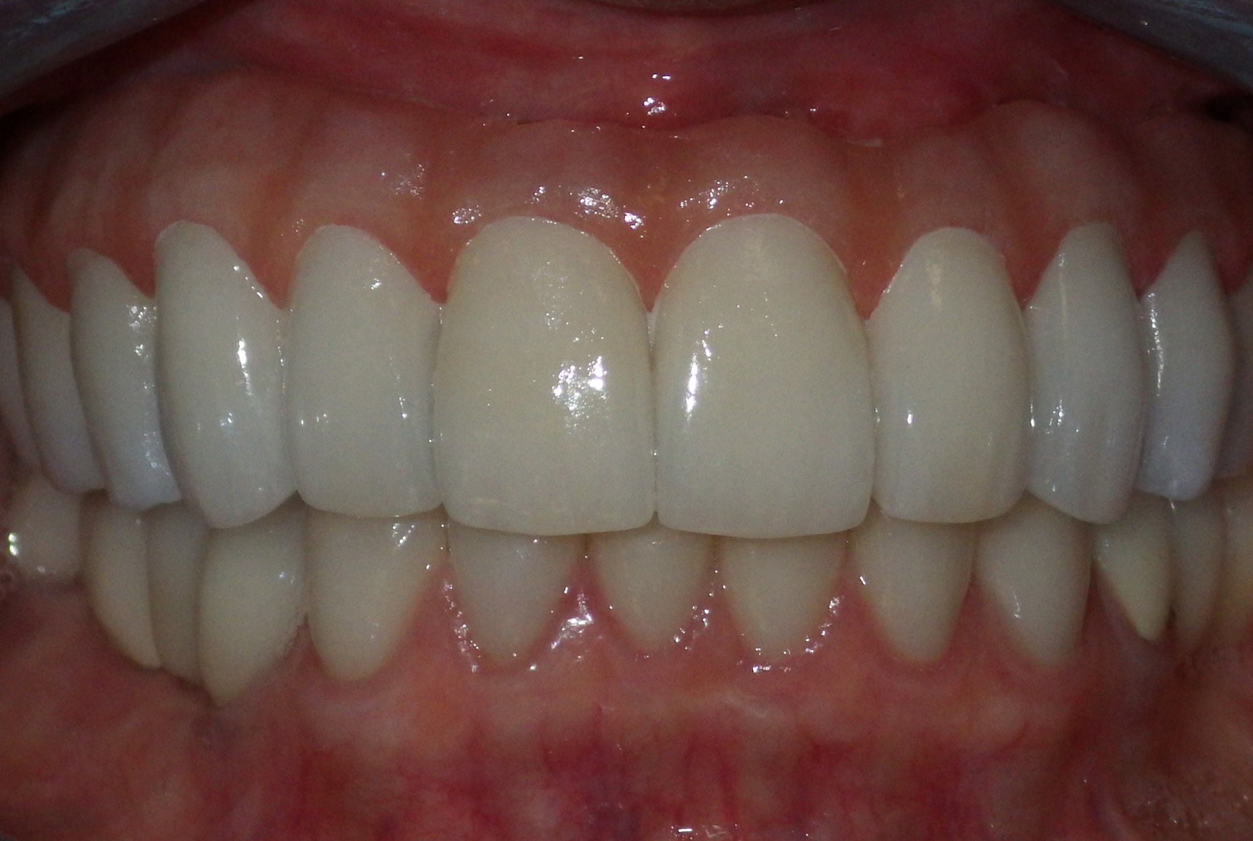Implant Dentures | Grove Dental Associates