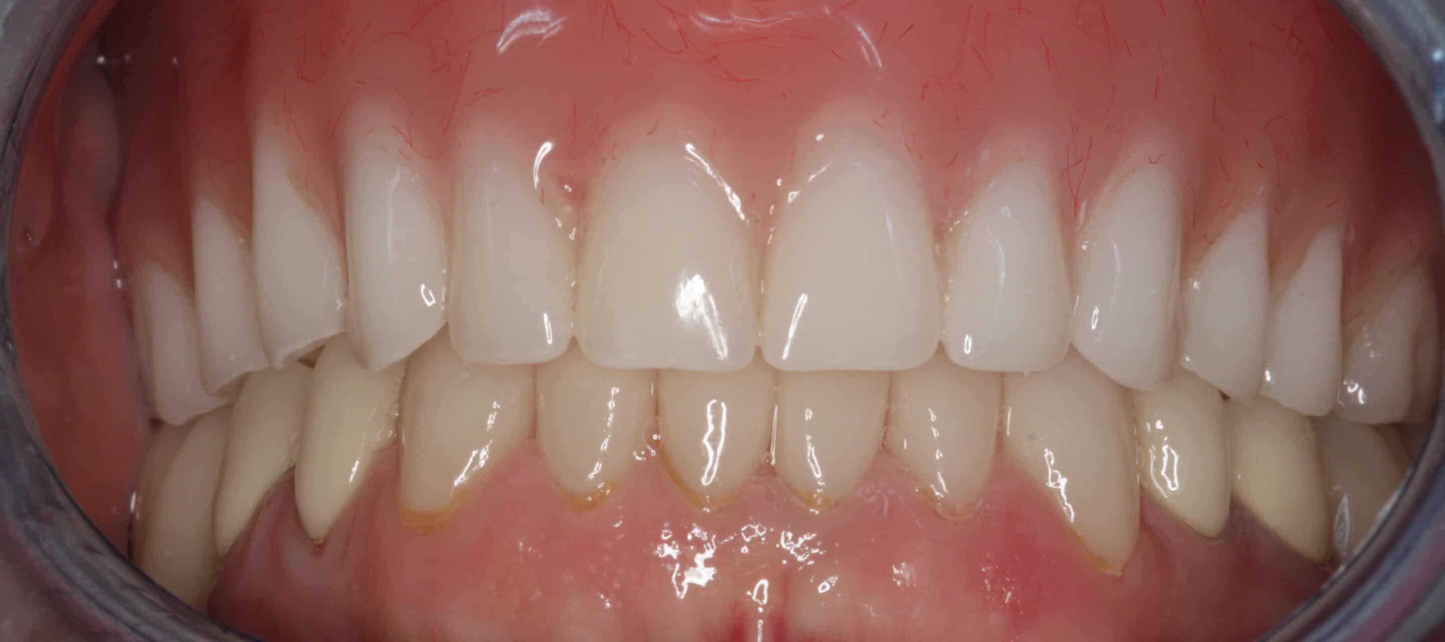 Removable Dentures | Grove Dental Associates