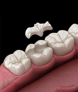 img-inlays-and-onlays